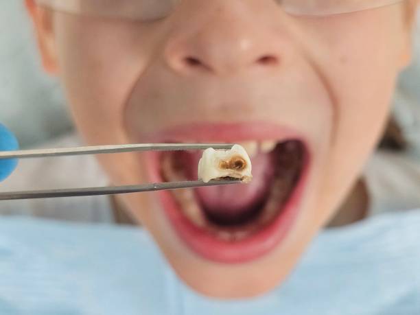 Best Emergency Dentist for Lost Fillings or Crowns in Bloomer, WI